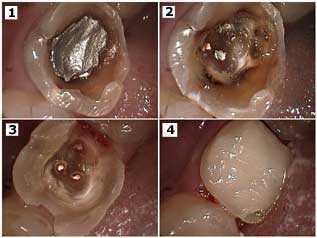 Large Silver Filling tooth teeth dental emergency decay cavity amalgam filling silver mouth