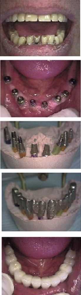 NY dental implants, NY dental implant dentist, New York dental implants, New York implant dentist