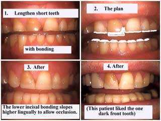 Resin bonding increases tooth length for short teeth