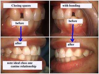 dentist bonding gaps bond dentistry bonded teeth gap gaps space