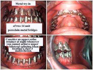 occlusion, class 3, class three, class III dental teeth bite prognathic jaw underbite treatment