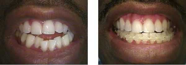 open bite treatment with braces, centric relation