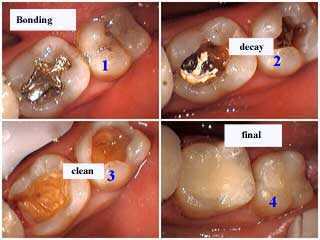 teeth bonding, fillings, restorations, operative dentistry, decay, bond cavity