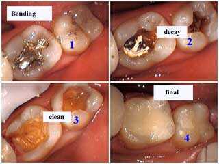 operative dentistry, bond, silver fillings, restorations, decay, cavity composite resin technique