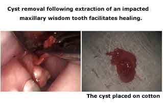 Wisdom teeth extraction full bony impactions, third 3rd molar, impaction, impacted oral surgery , extraction cyst removal