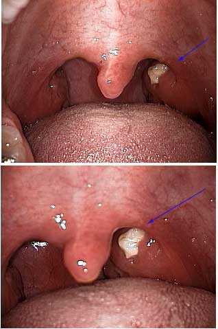 Oral Pathology, Dental Cysts, oral medicine disease, diagnois, Cryptic Tonsil, Purulence, purulent