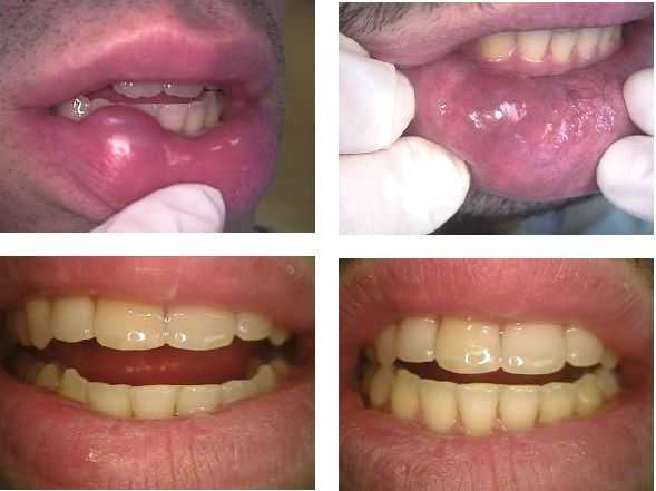 oral pathology medicine, mucocele recurrence, lip biting habit cheek, recurring, diagnosis, treatmen