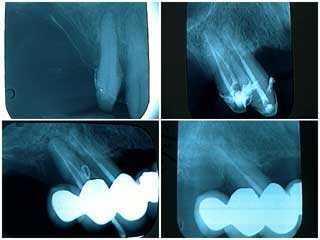 complications, fixed porcelain dental bridges, crown, cap, distal abutment failure, x-ray
