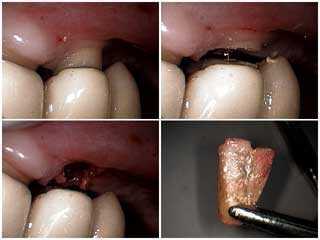 dental bridge removal, acute dental tooth abscess teeth periodontal probing pockets pocketing