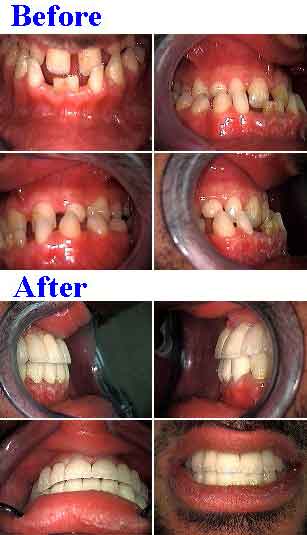 Full mouth reconstruction class three underbite, Bridges, fixed caps, dental crowns, porcelain metal, pfm, prognathic, oral rehab