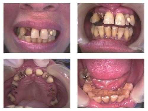 Oral Rehabilitation Dental Reconstruction Smile Makeover dental phobia anxiety fear of dentist afrai