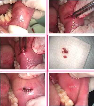 oral surgery, minor salivary gland lobules focal chronic sialadenitis, excisional biopsy excision