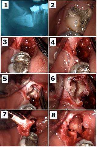 tooth Abscess teeth Pain Infection Extraction Wisdom Pericoronitis Second Molar horizontal Impactio