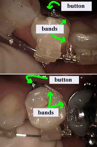 orthodontic rotation elastics, rotating teeth braces dental brackets, rubber bands pictures