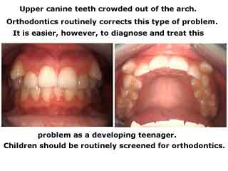 tooth impactions, impacted teeth, crooked, orthodontics, braces, arch form