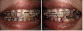 Faster braces Orthodontics with class two 2 elastics tooth root torquing archwire