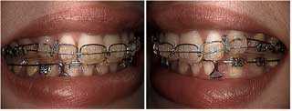 Discussion of orthodontic arch wire in dental braces