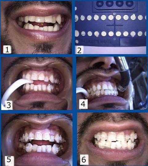 NY orthodontist and New York braces show brackets, archwire placement, and NiTi Nickel Titanium