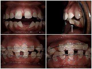orthodontic anchorage, braces, severe labial inclination, buck teeth, protrusion, protruded