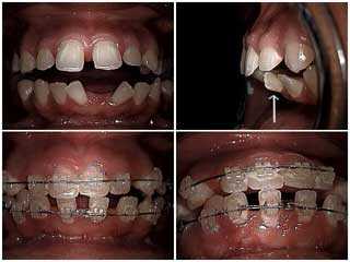 Orthodontics faster braces for spaces and buck teeth protrusion. Anchorage for midline elastics.