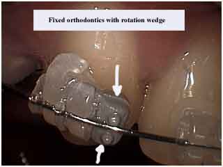 elastics fixed orthodontics, rotation wedge, braces, teeth rotated orthodontist