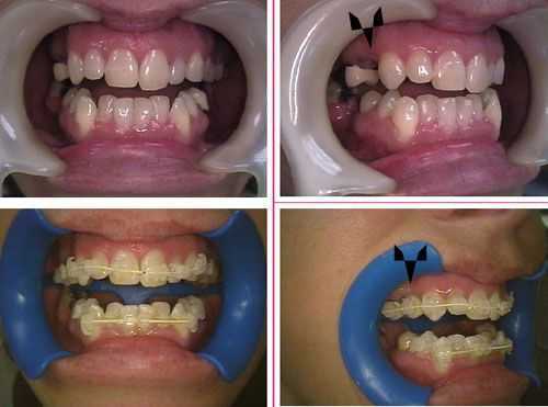 orthodontics braces missing false tooth teeth pontic space gap complications problems dental