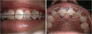 dental orthodontic arch length, lingual buttons, elastomeric rotators, braces orthodontics