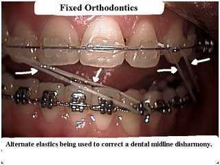 Orthodontics cosmetic clear faster braces invisible by our New York Orthodontist treats midline dental disharmony or symmetry.