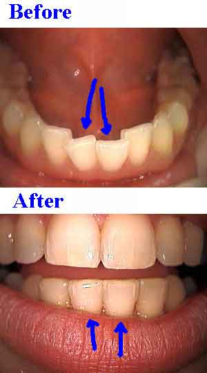 Cosmetic teeth clear faster braces invisible from our NY Orthodontist treats lower anterior crooked tooth.