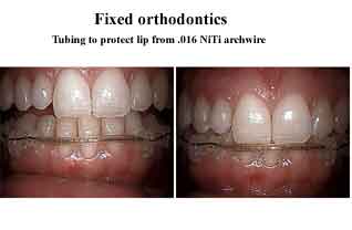 Orthodontics dental braces teeth tooth , archwire, lip bumper, tubing, problems complications