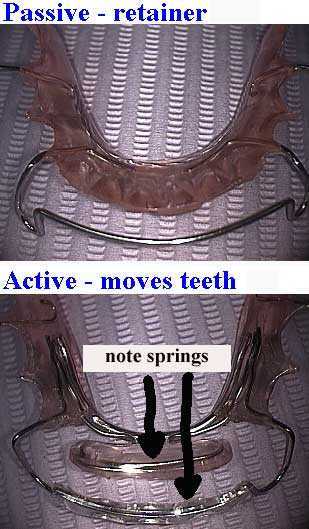 removable braces, orthodontics, passive active appliances, orthodontistry, hawley retainer