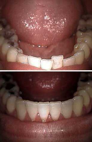 removable braces for crowded lower tooth, invisalign, crooked tooth, crowded, crowding