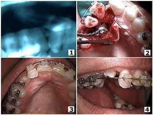 complications orthodontics, tooth teeth braces dental orthodontist problems Forced Eruption Surgery