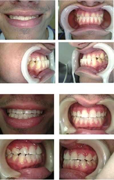 orthognathic oral surgery, orthodontics, teeth braces, dentoalveolar, prognathic jaw