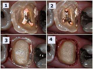 how to drill crown buildup cap bevel shoulder root canal orifices mechanical retention drilling