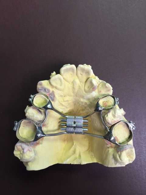 Palatal Expander, orthodontic expansion, Invisalign