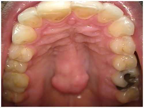 palatal torus palatinus torii picture photo diagnosis dental symptoms treatment cure