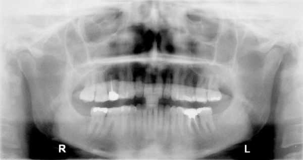 panoramic radiograph, TMD panorex, TMJ xray, temporomandibular joint