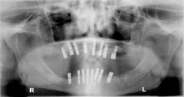 Panoramic x-ray showing 16 dental implants. Radiograph of Implant Dentistry.