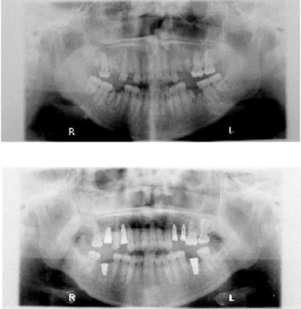 panoramic x-rays radiographs, oral rehabilitation with dental implants smile makeover 