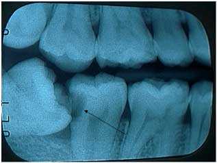 tooth impactions, impacted teeth, Rationale for Extraction, X-ray, why, reason