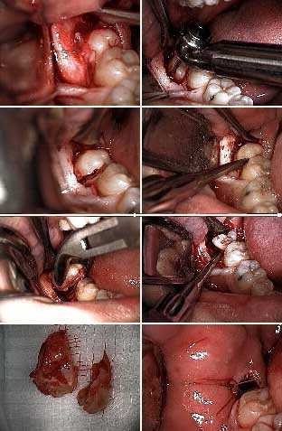 tooth extraction oral surgery wisdom teeth third molars 3rd soft tissue reflection how to