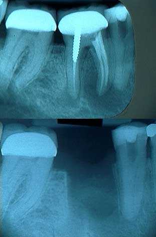 periapical pathology radiolucency x-ray endodontics root canal problems failure infection swelling