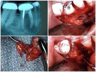 tooth extraction periapical radiolucency hopeless fenestration oral surgery cyst pain infection