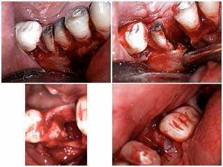 how to extract tooth extraction periapical radiolucency hemisection resection oral surgery pain