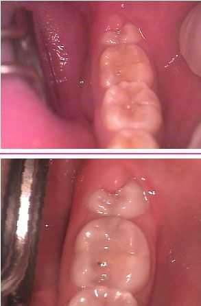 pericoronitis infection