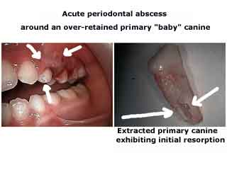 Periodontal abscess gum gingival teeth infection primary teeth deciduous baby tooth