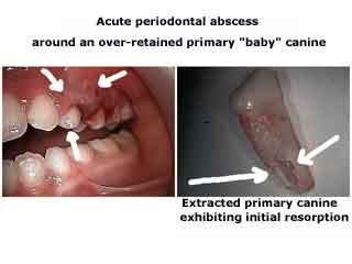 primary baby teeth tooth dentistry pediatric dentist kids children gum abscess gingival deciduous