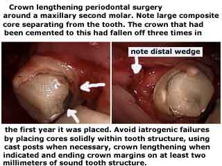 tooth failure complications problems crowns caps buildup composite core margins