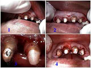 gums gum surgery disease treatment periodontal Gingivectomy crown lengthening short clinical crowns